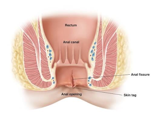 Posterior-midline anal fissure with a sentinel tag.