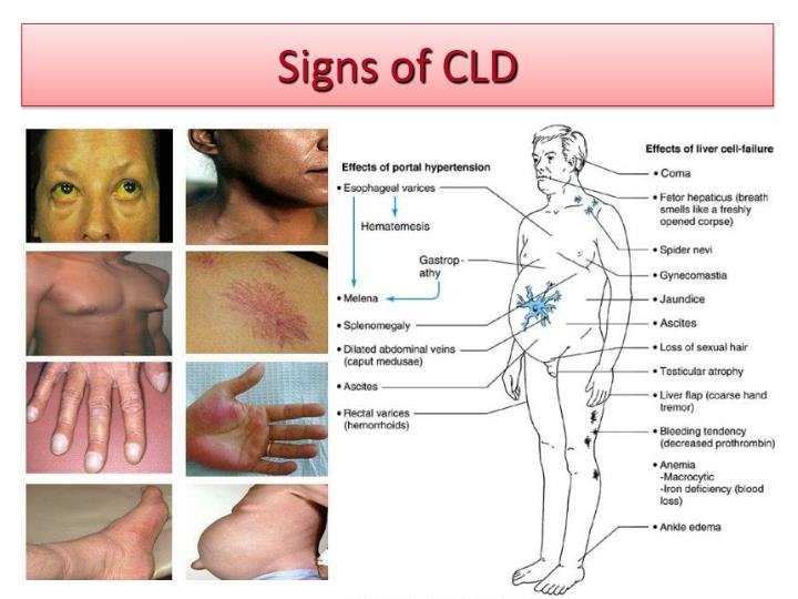 Peripheral stigmata of chronic liver disease.