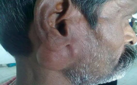 Pleomorphic adenoma: a slow-growing painless lump at the angle of the jaw with facial nerve preserved.