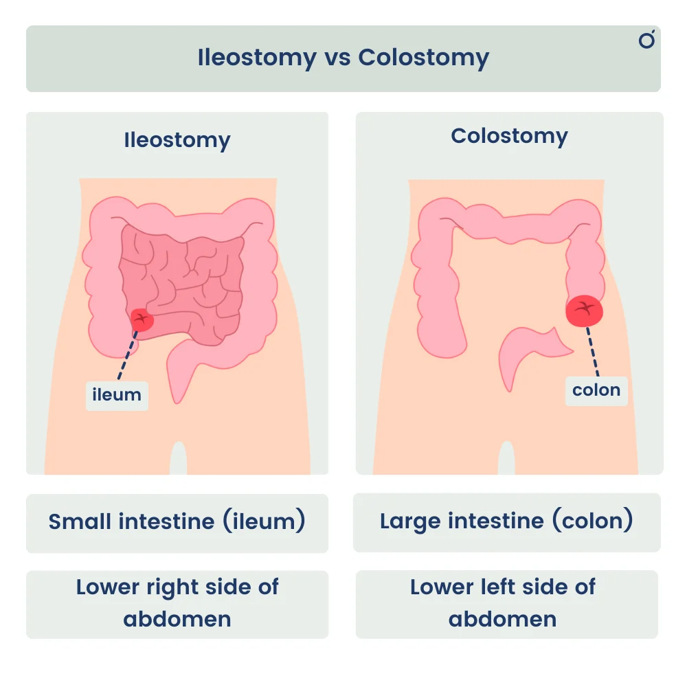 Distinguishing a colostomy (flush, left iliac fossa) from an ileostomy (spouted, right iliac fossa).