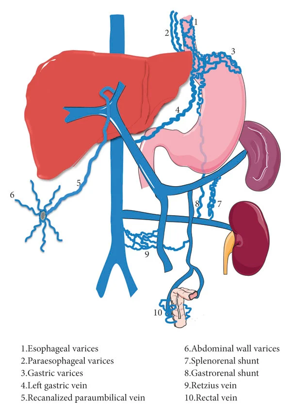 Portosystemic anastomoses in portal hypertension.