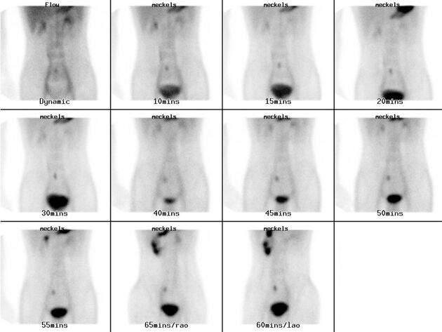 Technetium-99m pertechnetate (Meckel) scan showing ectopic gastric mucosa in a Meckel diverticulum.