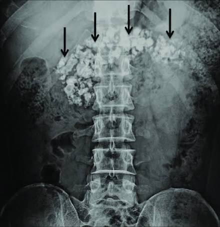 Pancreatic calcification in chronic pancreatitis.