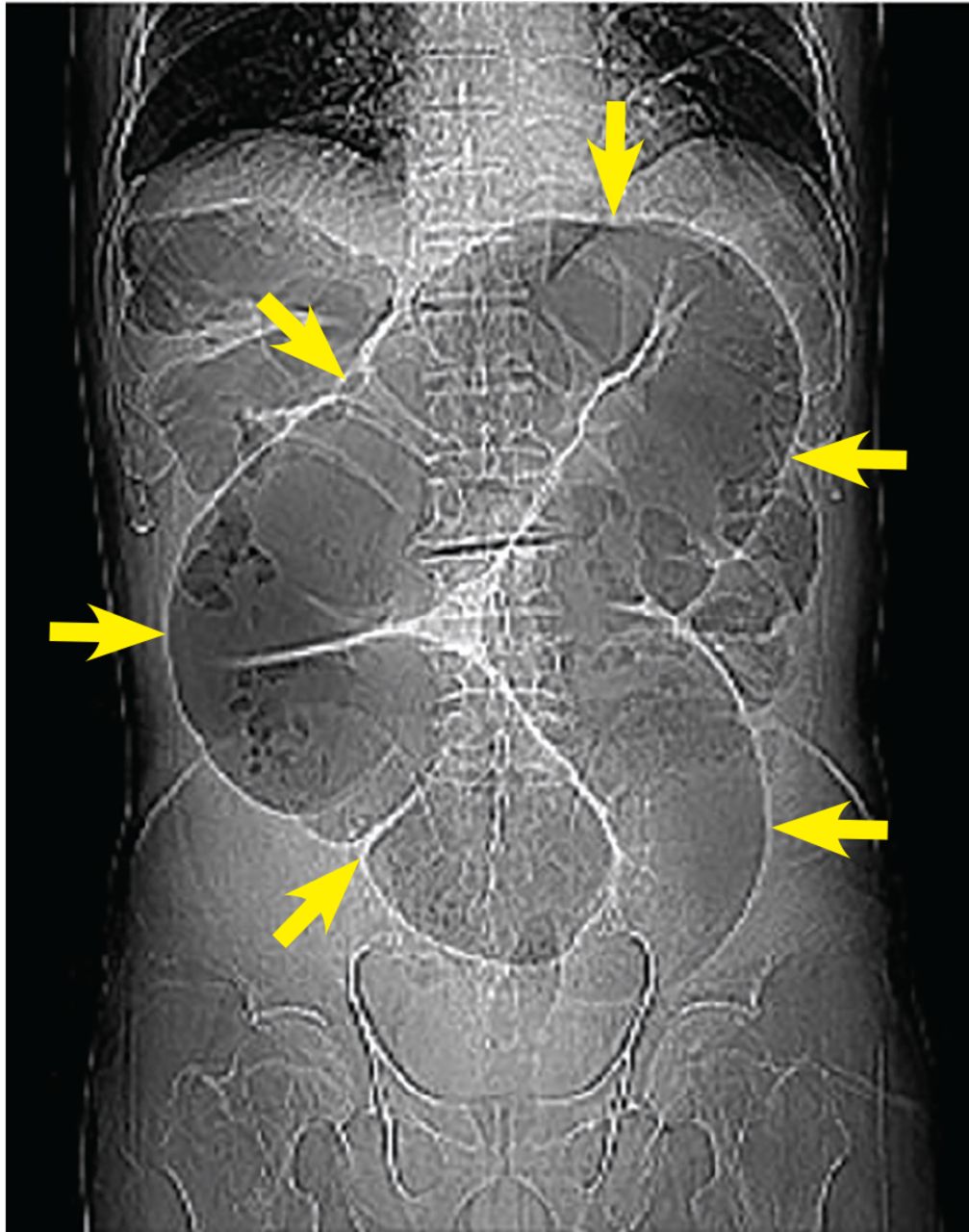 Coffee-bean sign of sigmoid volvulus on a plain abdominal film.