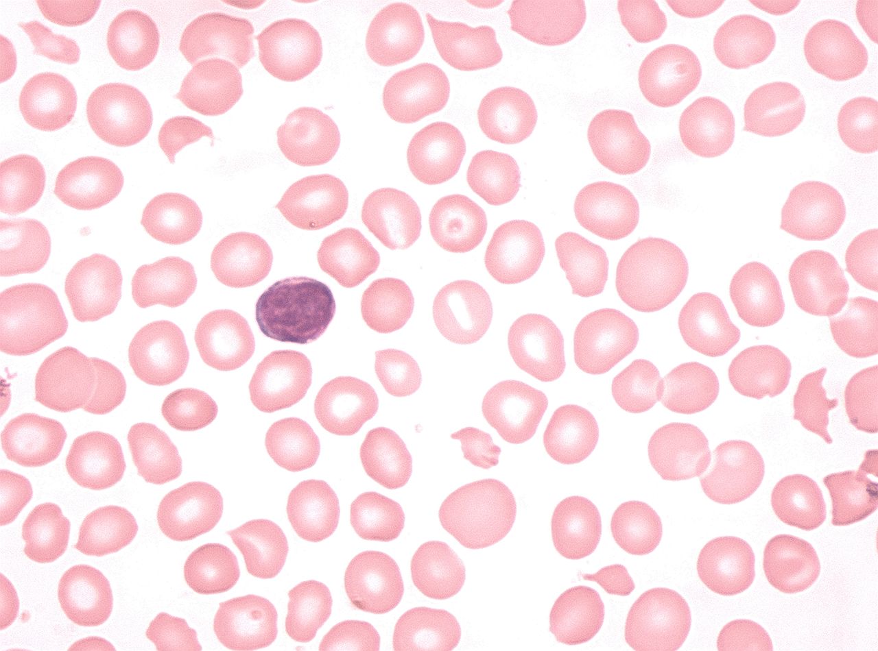 Blood film in iron-deficiency anaemia of pregnancy