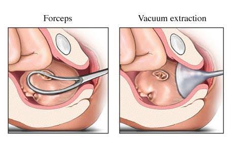 Forceps versus vacuum (ventouse) assisted delivery