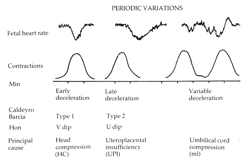 CTG deceleration types: early, variable and late decelerations relative to uterine contractions