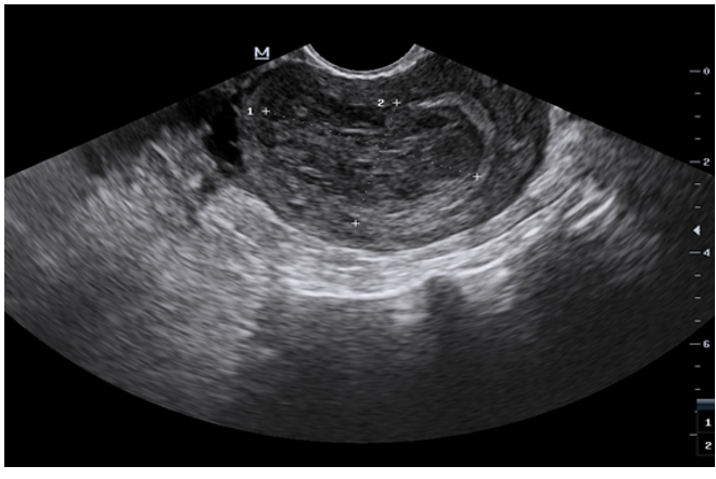 Transvaginal ultrasound of a thickened endometrium