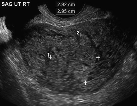 Ultrasound 'snowstorm' of a molar pregnancy