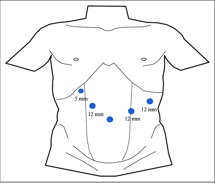 Laparoscopic port placement