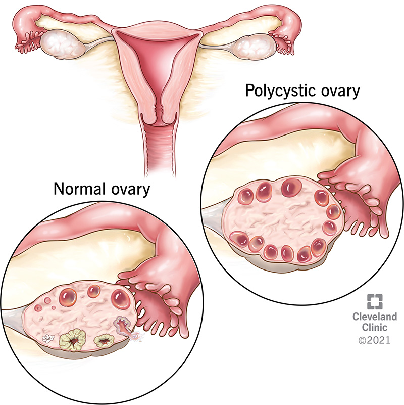 Polycystic ovarian morphology on ultrasound