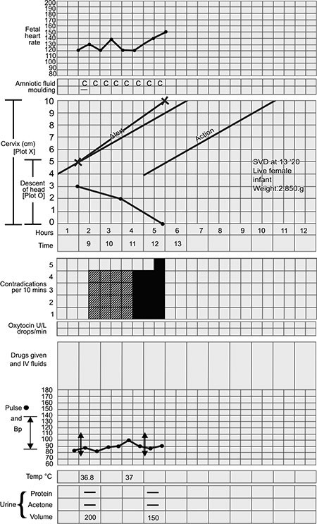 Normal WHO partogram: cervical dilatation and descent plotted against the alert and action lines
