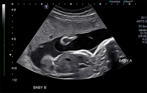 Twin-to-twin transfusion syndrome